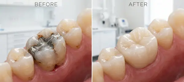Why Choose Dental Crowns