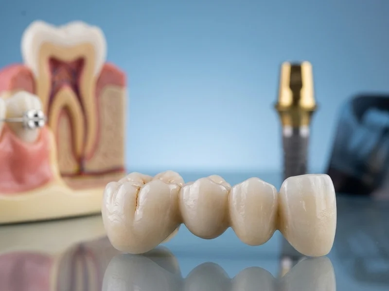 Dental Bridges Restoration